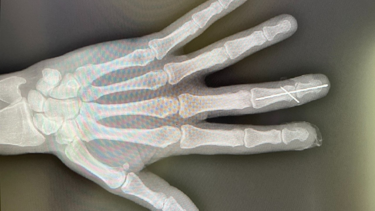 An X-ray of a hand, with a surgical pin set through the ring finger